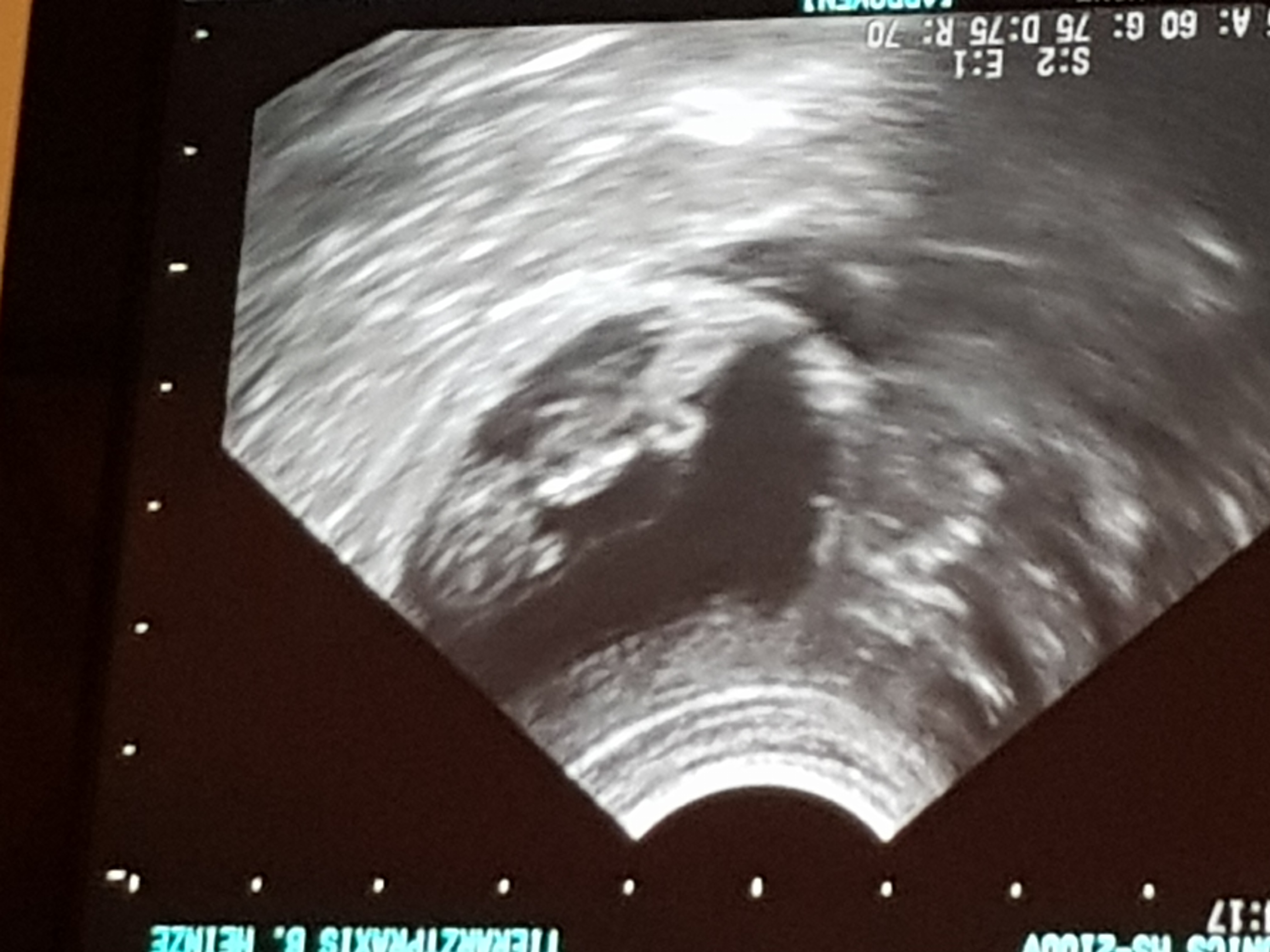 Gyda Ultraschall